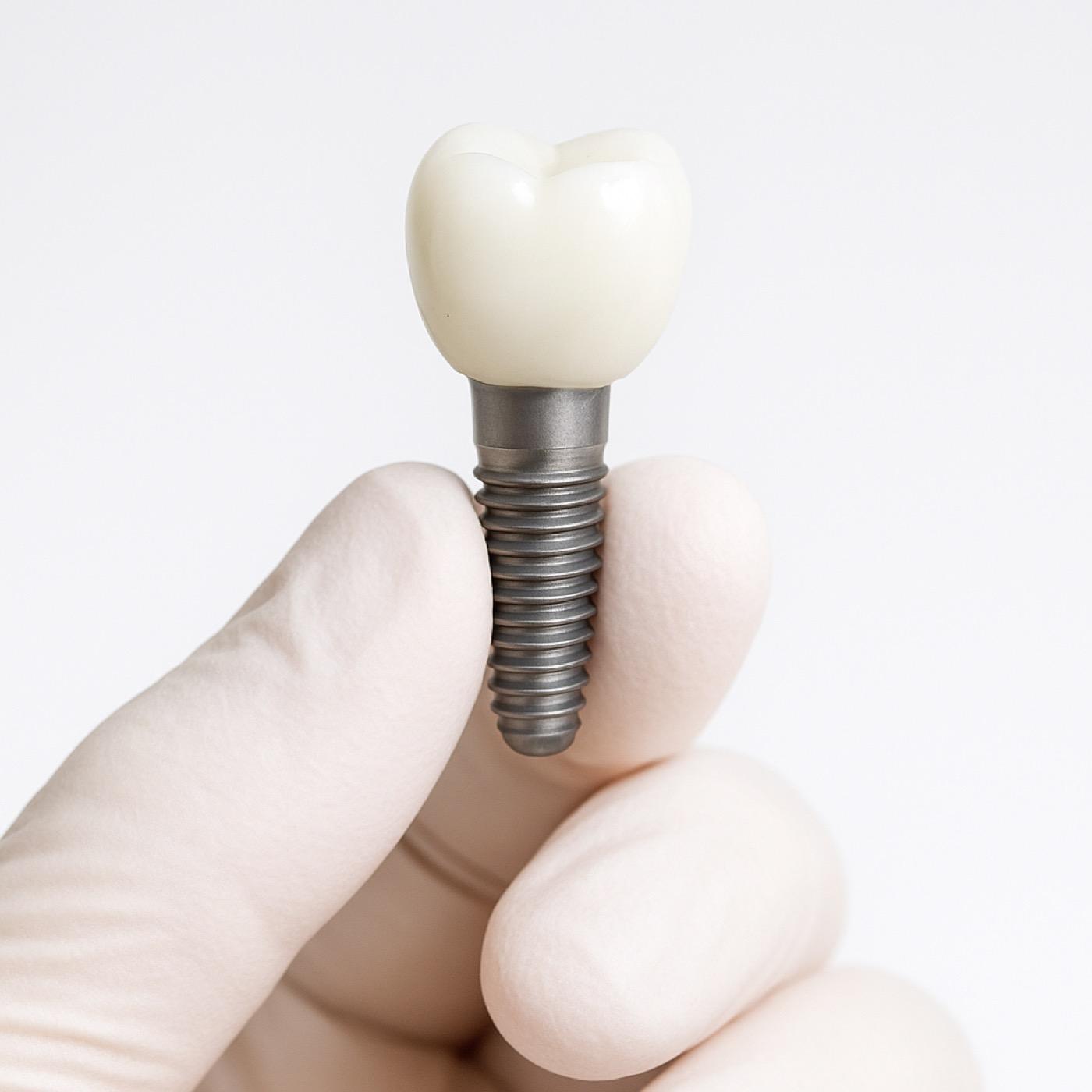 Dental Implants